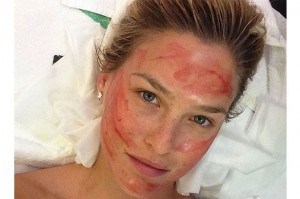 vampire facial bar refaeli