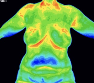 a normal breast thermogram