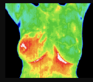 abnormal breast thermogram